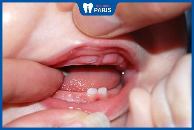 Bé bị hôi miệng khi mọc răng do đâu: Nguyên nhân & Cách xử lý